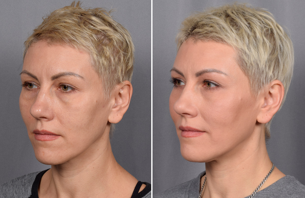CO2 Laser Before & After Gallery - Patient 637576 - Image 4