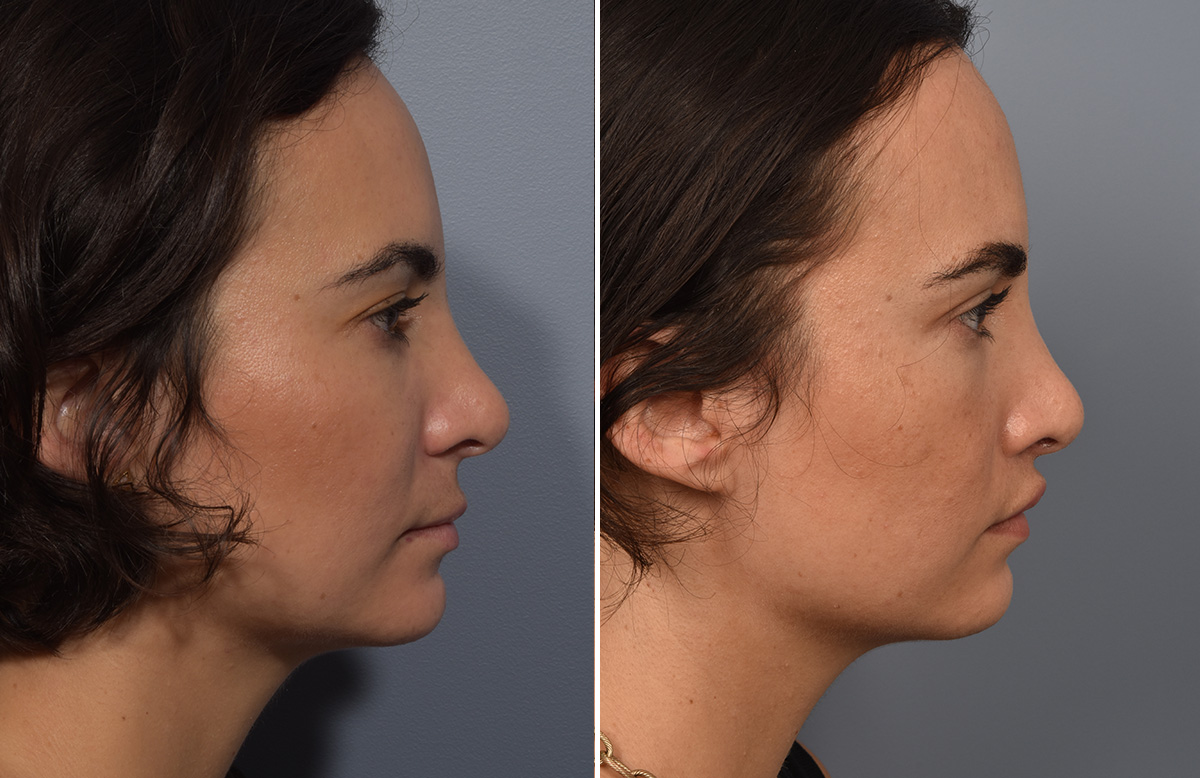 Lip Lift Before & After Gallery - Patient 237039 - Image 9
