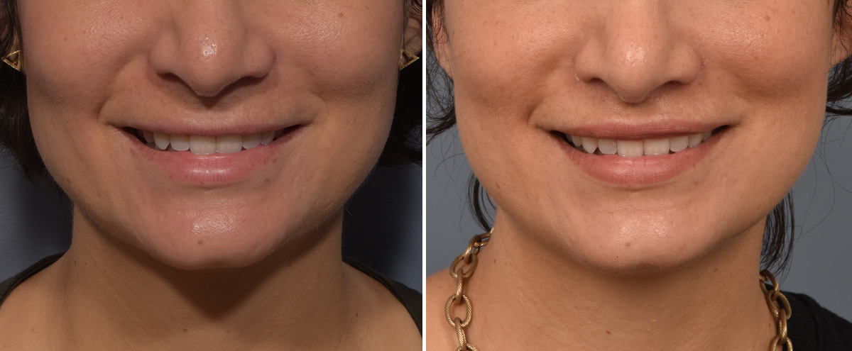 Lip Lift Before & After Gallery - Patient 237039 - Image 2
