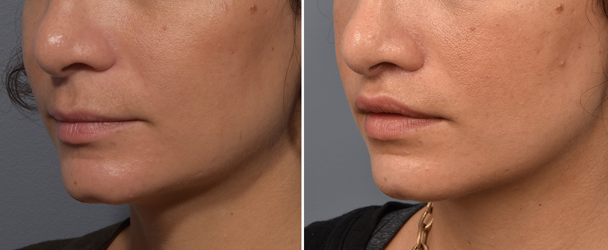 Lip Lift Before & After Gallery - Patient 237039 - Image 4