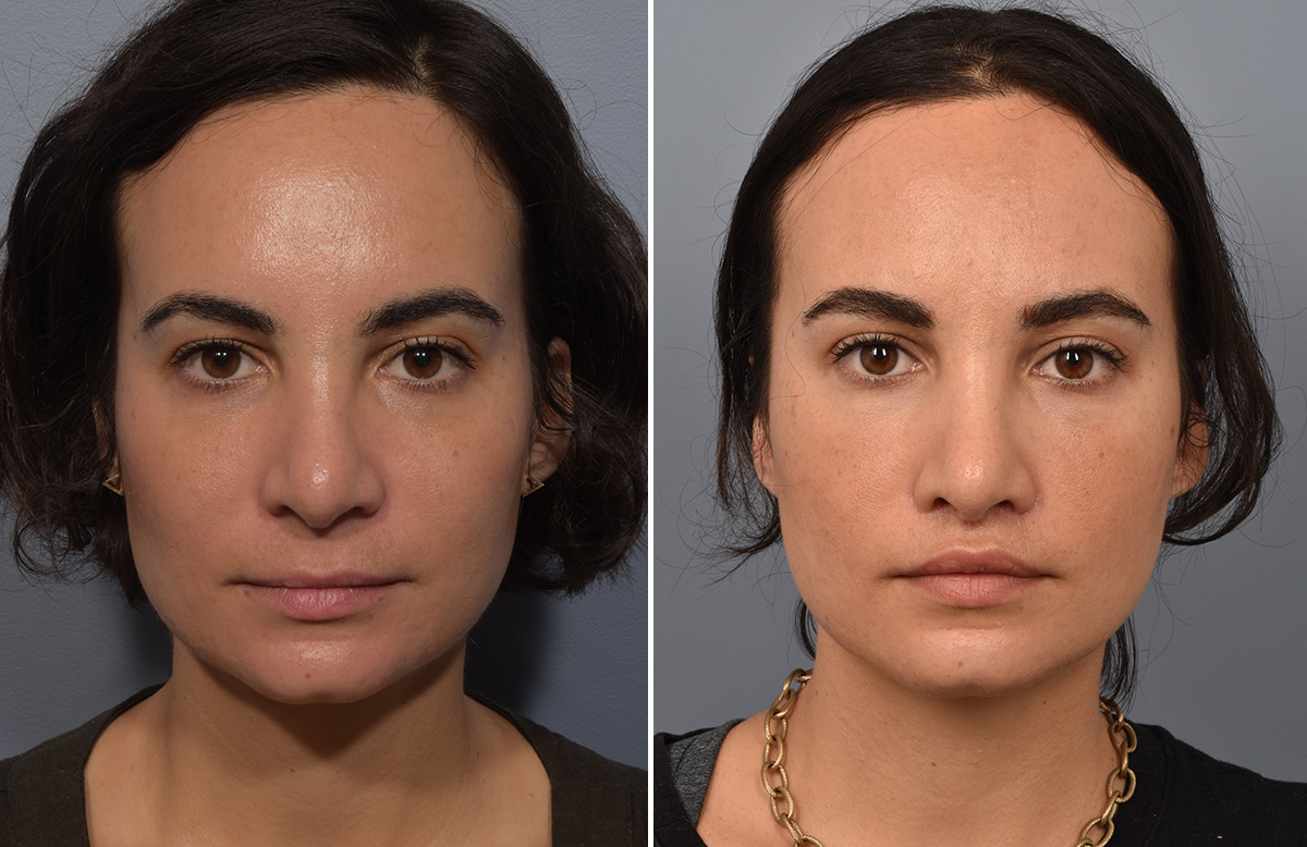 Lip Lift Before & After Gallery - Patient 237039 - Image 6