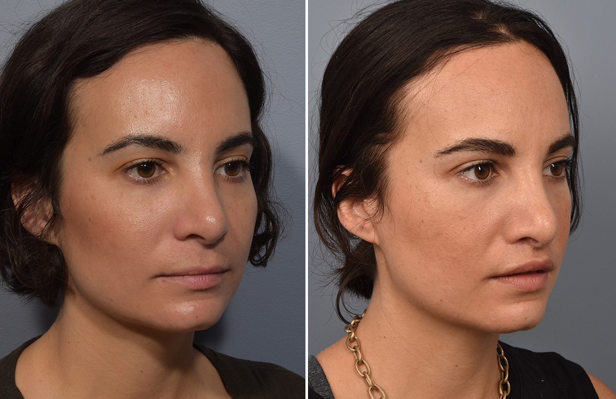 Lip Lift Before & After Gallery - Patient 237039 - Image 8