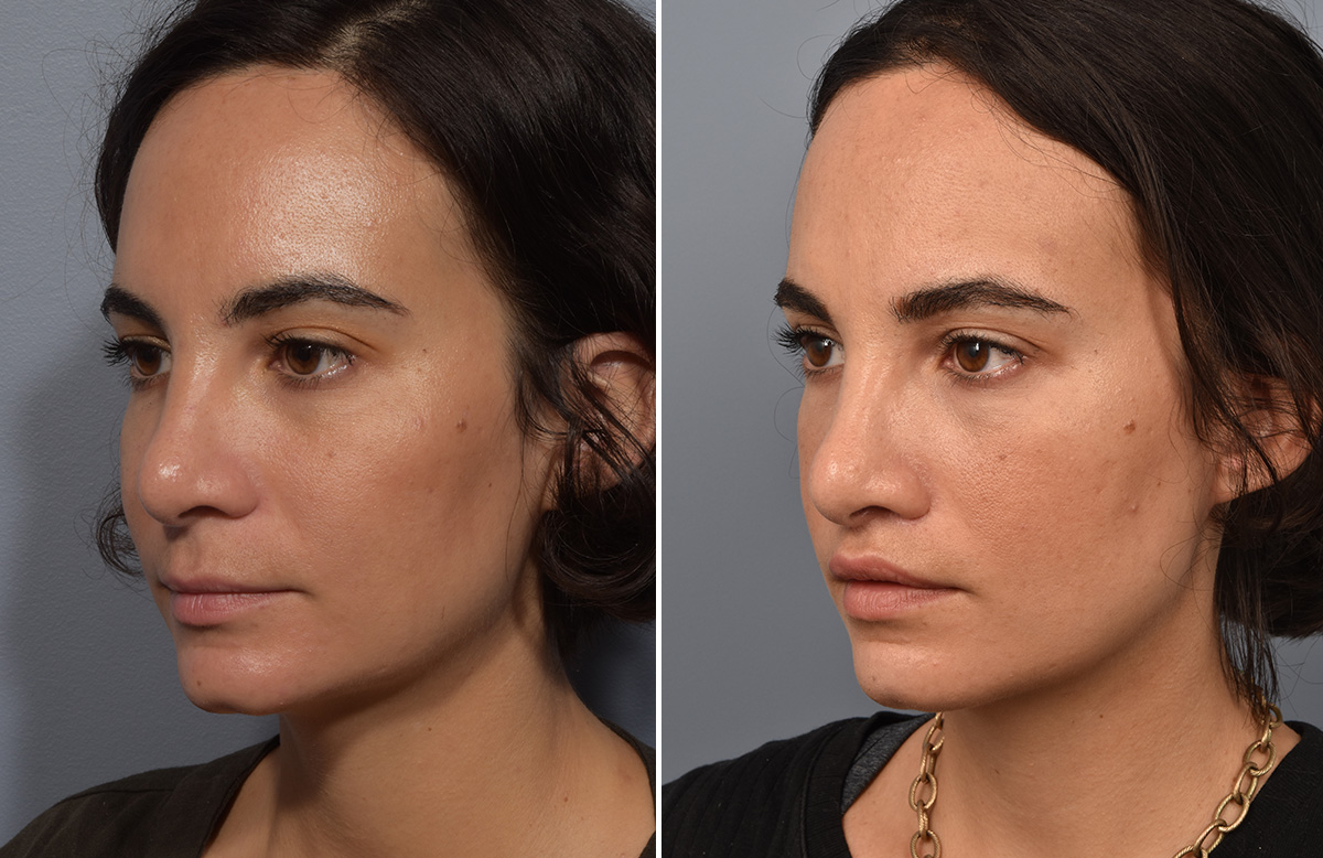 Lip Lift Before & After Gallery - Patient 237039 - Image 10