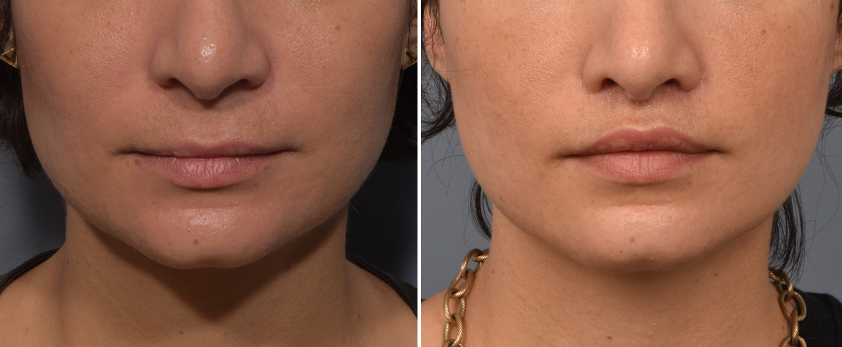 Lip Lift Before & After Gallery - Patient 237039 - Image 1
