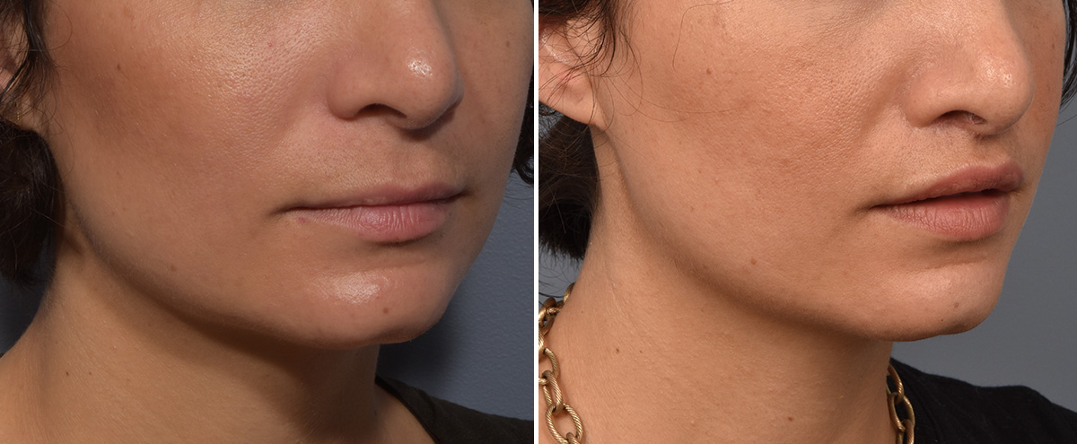 Lip Lift Before & After Gallery - Patient 237039 - Image 3
