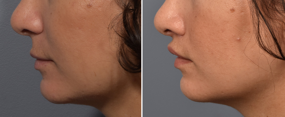 Lip Lift Before & After Gallery - Patient 237039 - Image 5