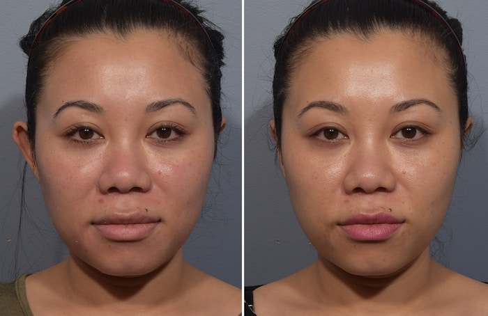 Otoplasty Before & After Gallery - Patient 427338 - Image 1