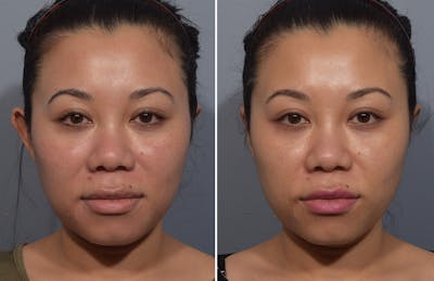 Otoplasty Before & After Gallery - Patient 427338 - Image 1