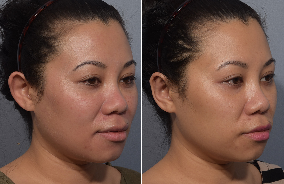 Otoplasty Before & After Gallery - Patient 427338 - Image 2