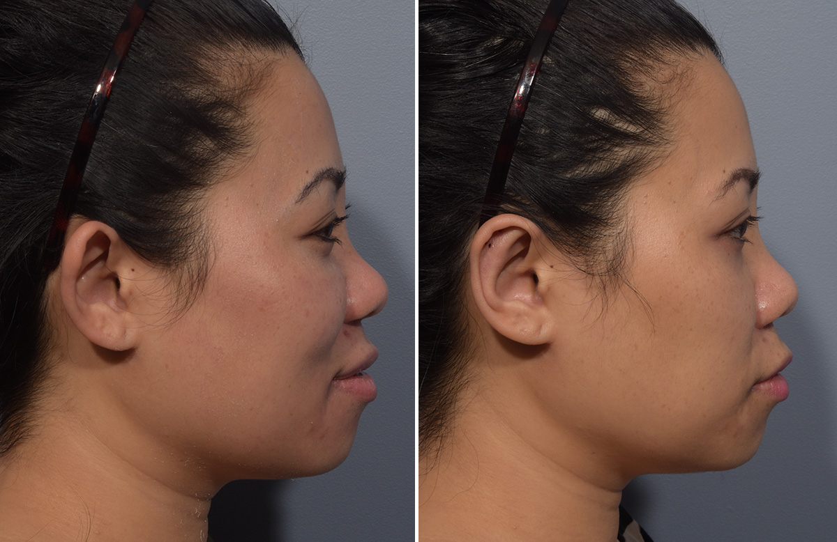 Otoplasty Before & After Gallery - Patient 427338 - Image 3