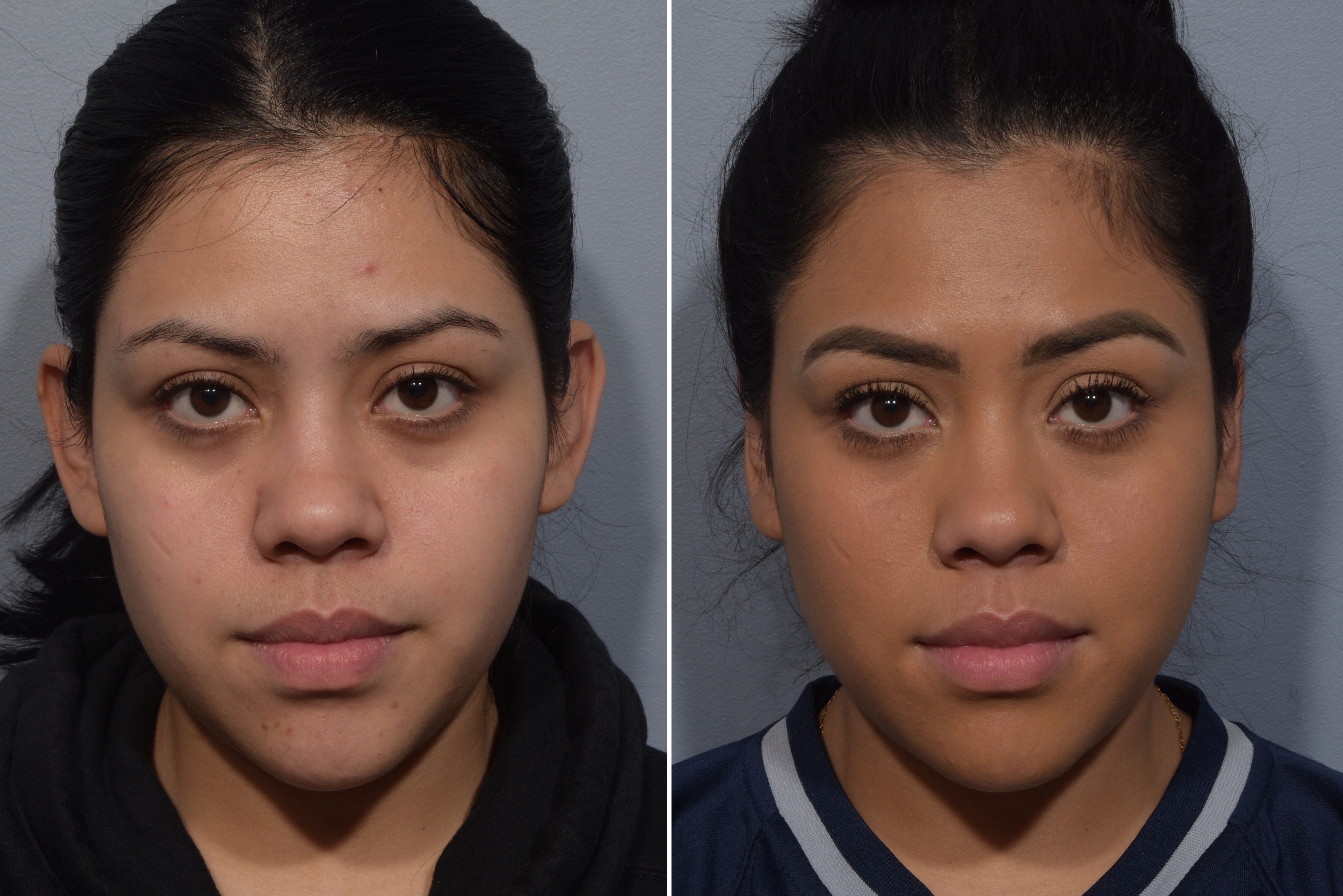 Otoplasty Before & After Gallery - Patient 984917 - Image 1