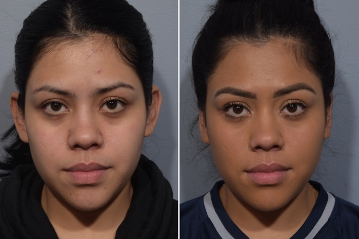 Otoplasty Before & After Gallery - Patient 984917 - Image 1