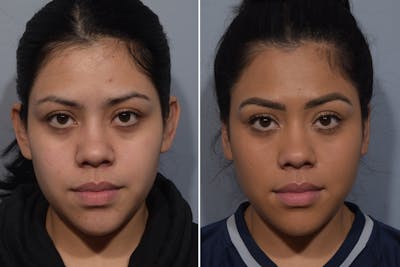 Otoplasty Before & After Gallery - Patient 984917 - Image 1