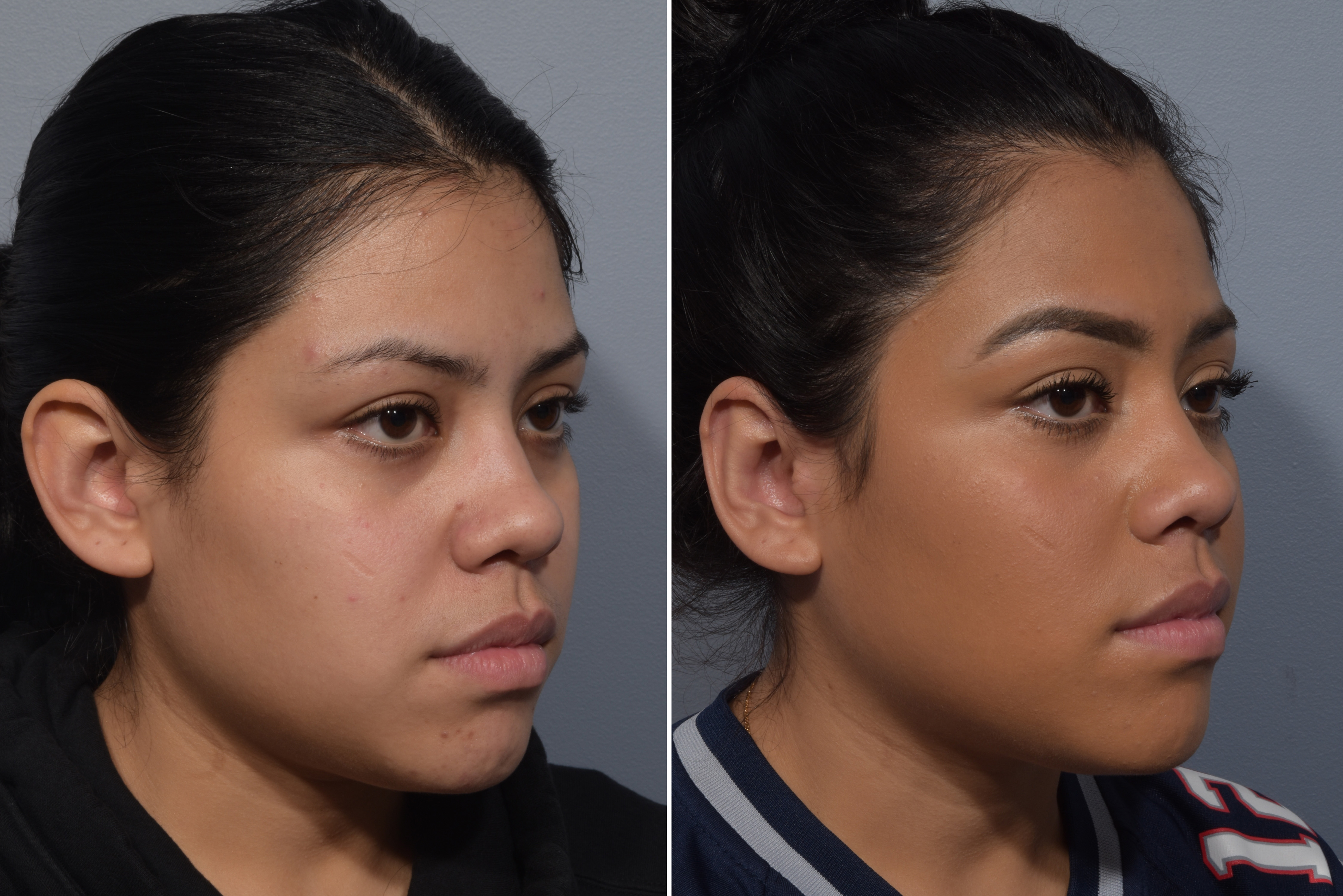Otoplasty Before & After Gallery - Patient 984917 - Image 2