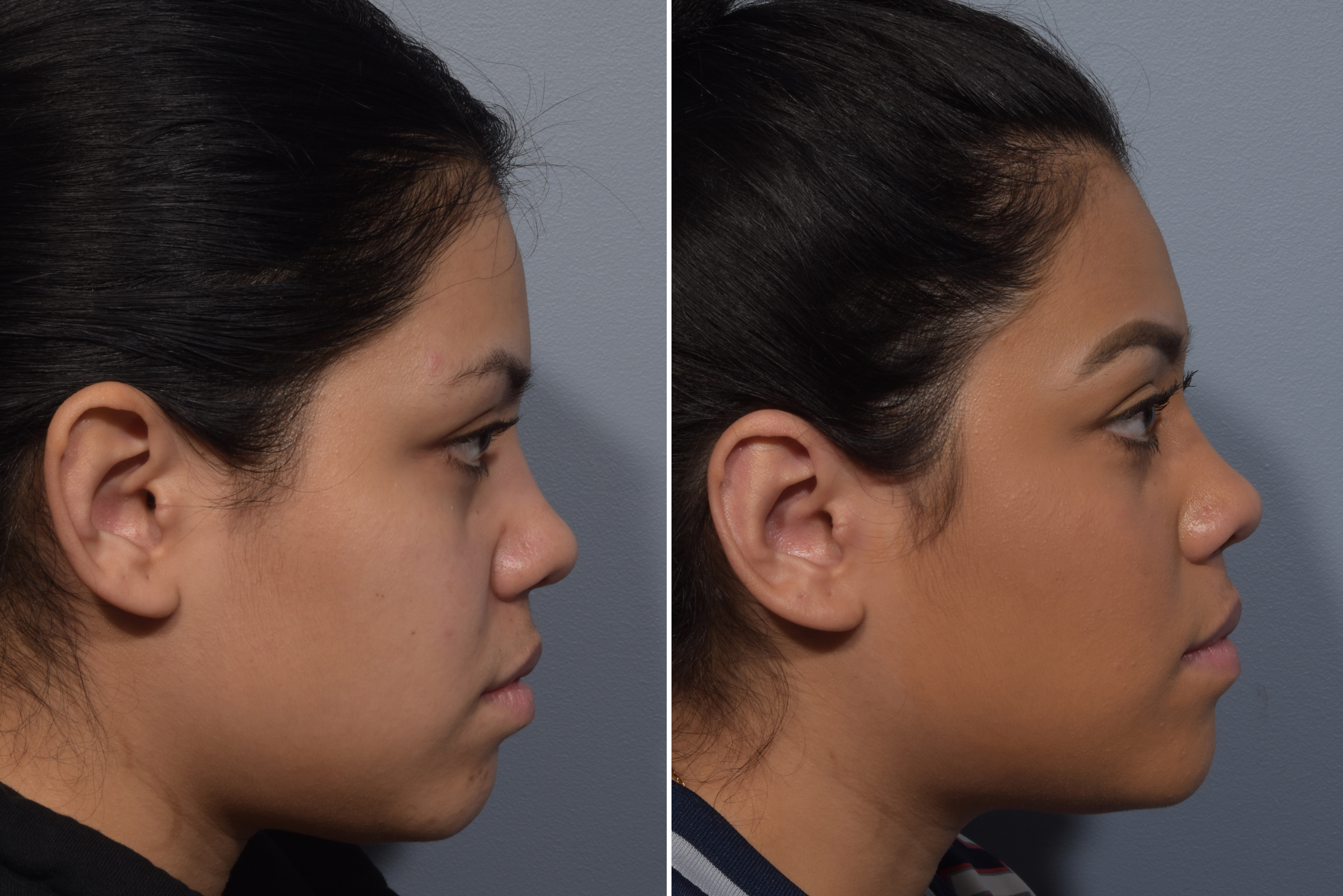 Otoplasty Before & After Gallery - Patient 984917 - Image 3