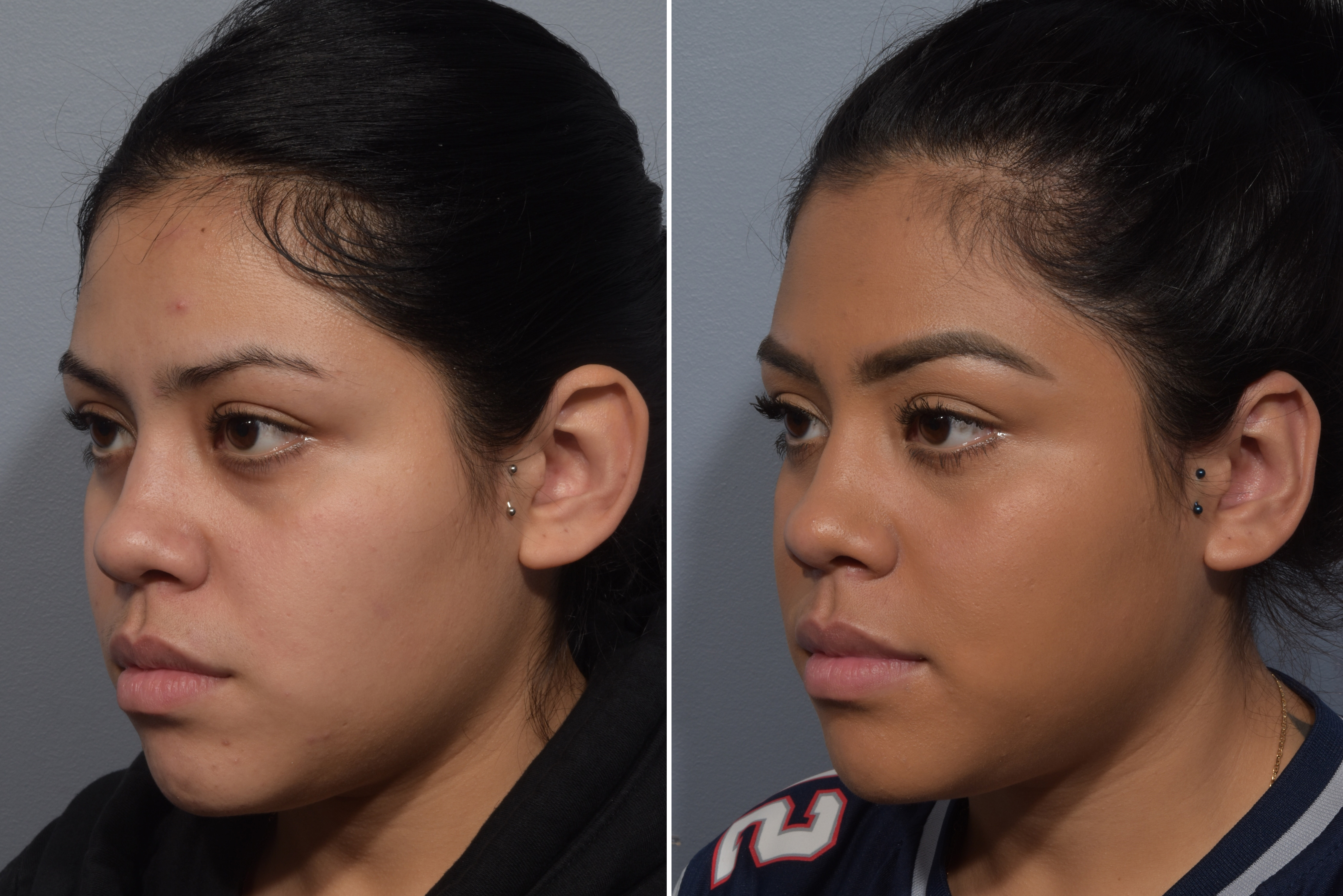 Otoplasty Before & After Gallery - Patient 984917 - Image 4