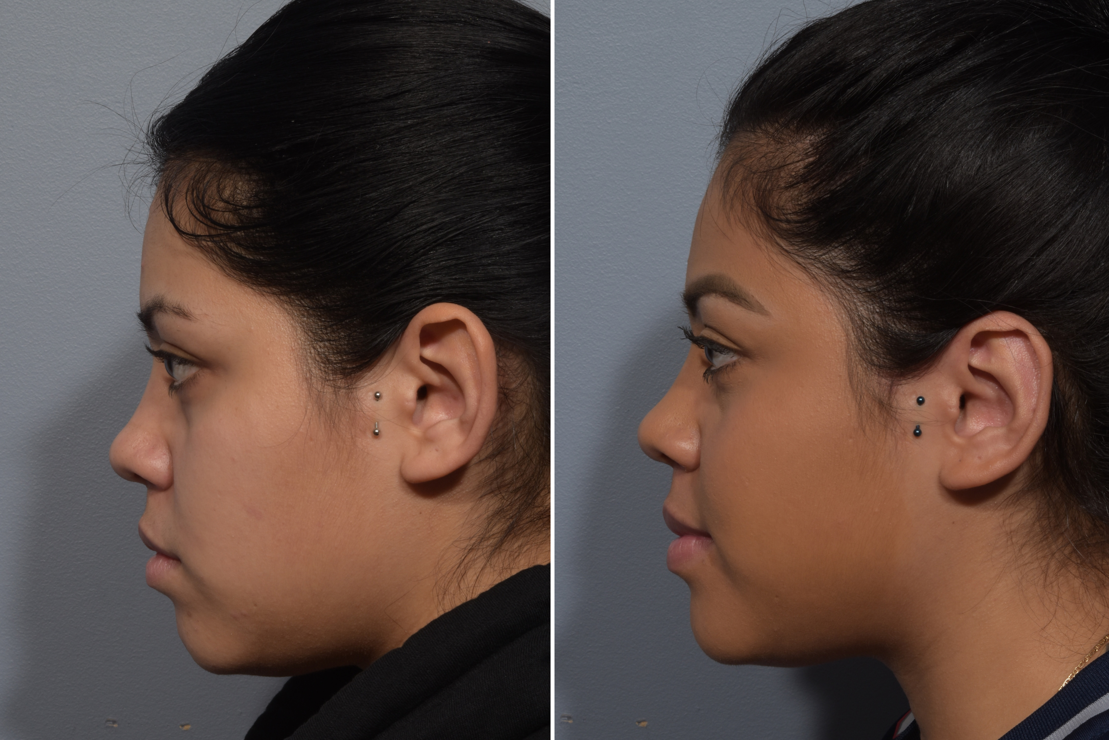 Otoplasty Before & After Gallery - Patient 984917 - Image 5