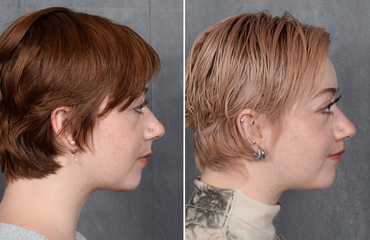 Lip Lift Before & After Gallery - Patient 310002 - Image 10