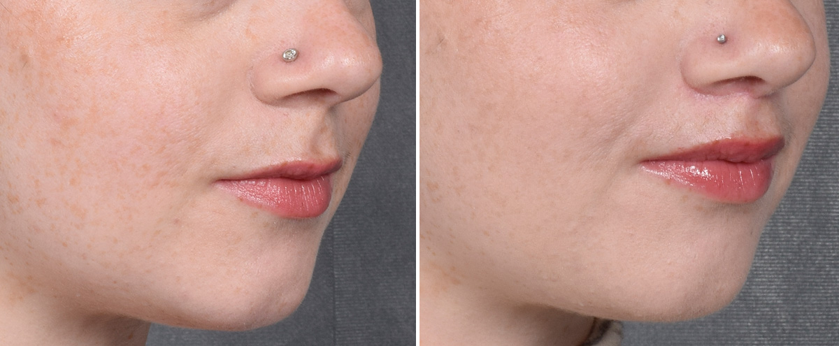 Lip Lift Before & After Gallery - Patient 310002 - Image 3