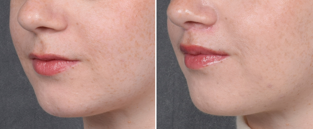 Lip Lift Before & After Gallery - Patient 310002 - Image 5