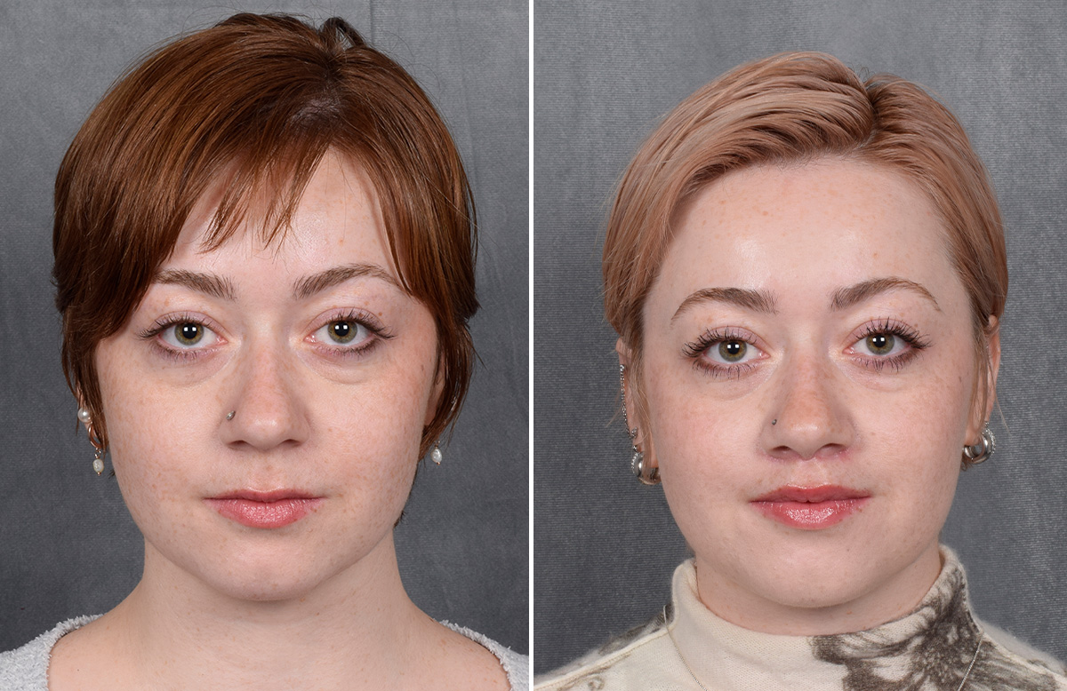 Lip Lift Before & After Gallery - Patient 310002 - Image 7