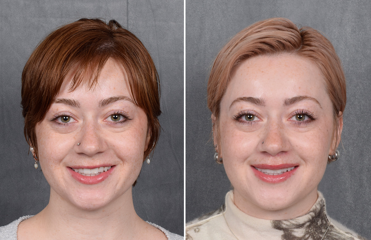 Lip Lift Before & After Gallery - Patient 310002 - Image 8
