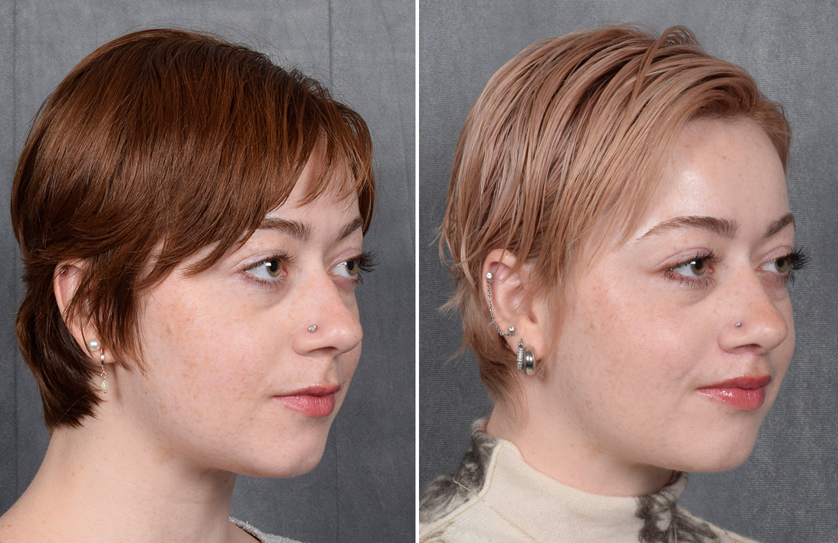 Lip Lift Before & After Gallery - Patient 310002 - Image 9