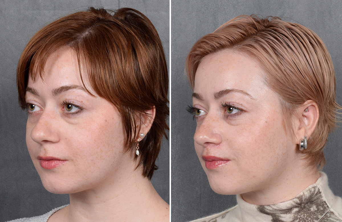 Lip Lift Before & After Gallery - Patient 310002 - Image 11
