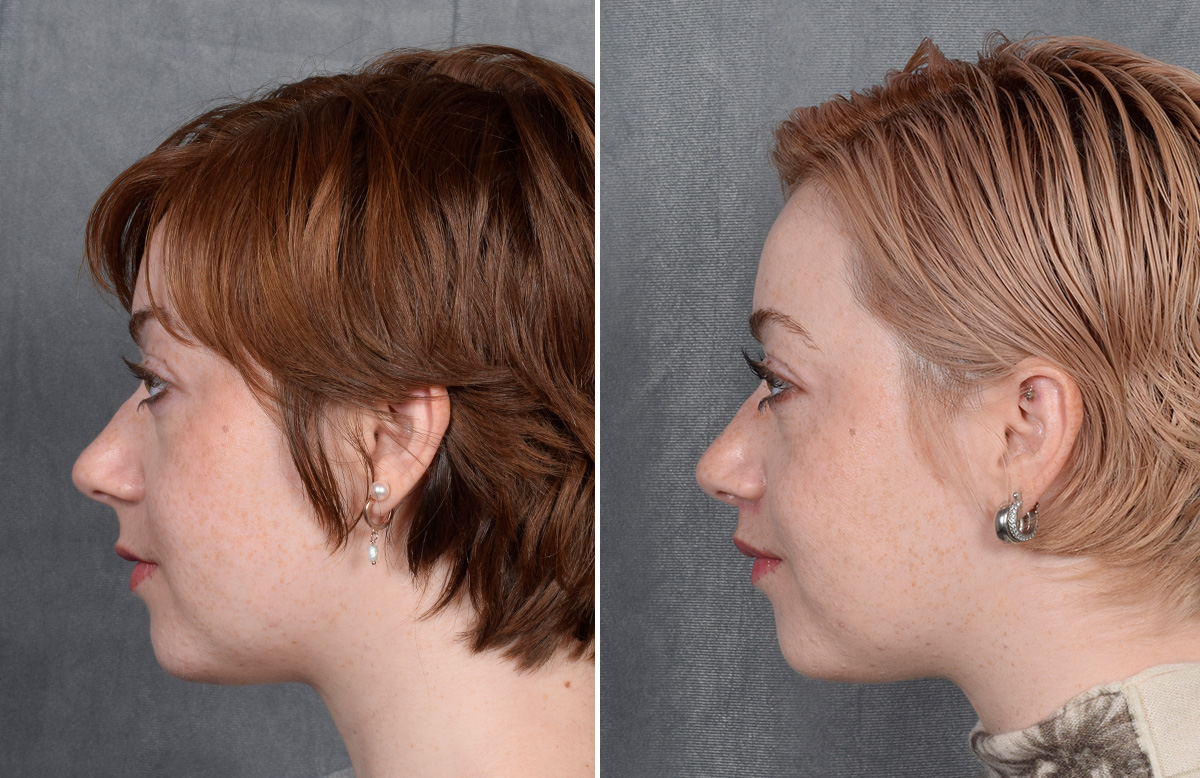 Lip Lift Before & After Gallery - Patient 310002 - Image 12