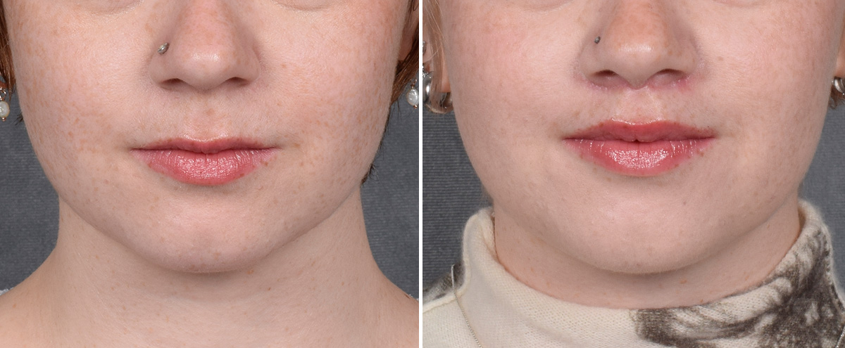 Lip Lift Before & After Gallery - Patient 310002 - Image 1