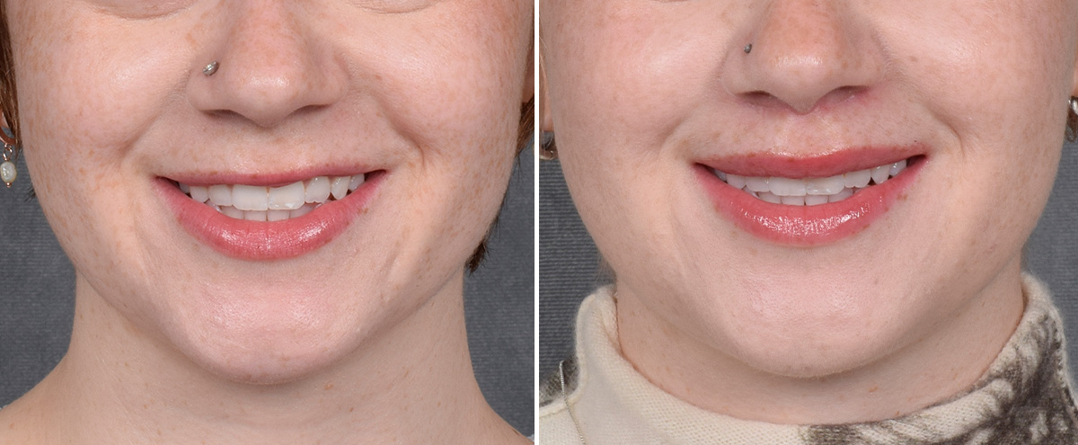 Lip Lift Before & After Gallery - Patient 310002 - Image 2