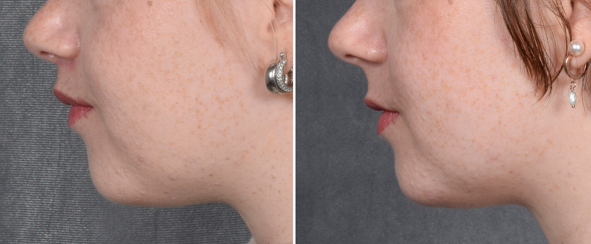 Lip Lift Before & After Gallery - Patient 310002 - Image 6
