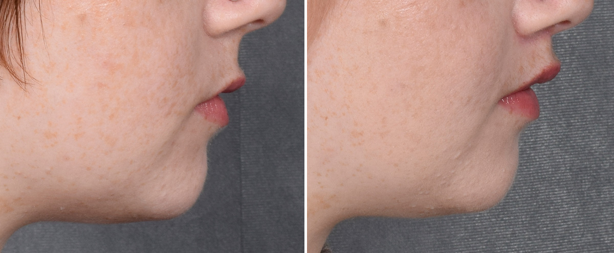 Lip Lift Before & After Gallery - Patient 310002 - Image 4