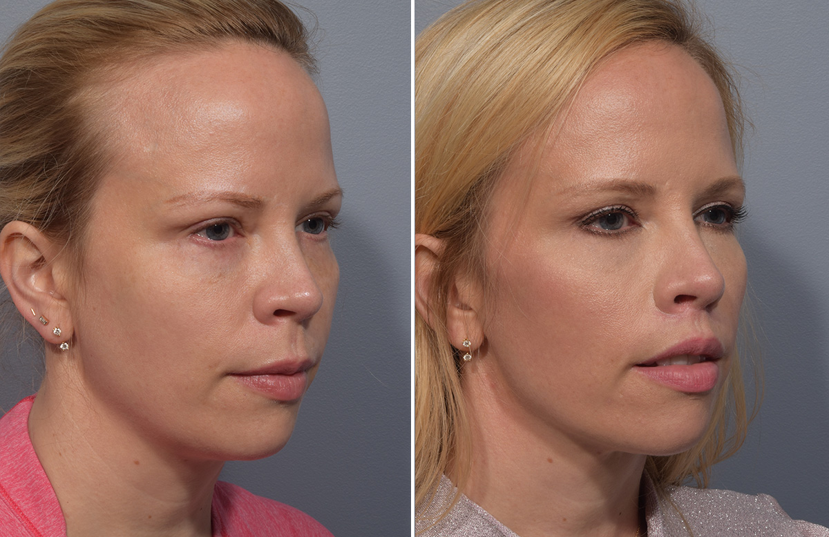 Lip Lift Before & After Gallery - Patient 393918 - Image 7
