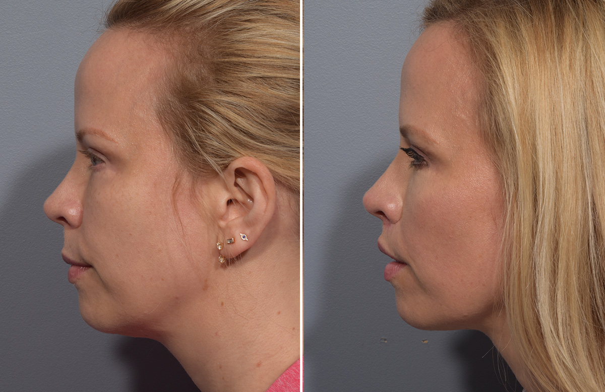 Lip Lift Before & After Gallery - Patient 393918 - Image 10