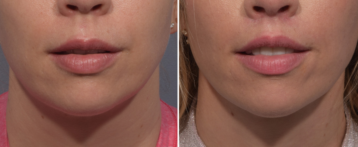 Lip Lift Before & After Gallery - Patient 393918 - Image 1