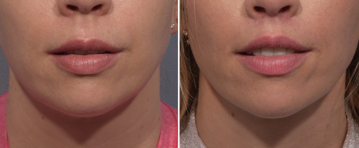 Lip Lift Before & After Gallery - Patient 393918 - Image 1