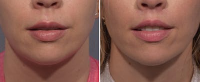 Lip Lift Before & After Gallery - Patient 393918 - Image 1