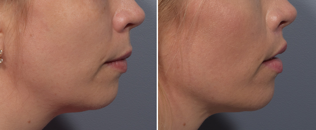 Lip Lift Before & After Gallery - Patient 393918 - Image 3