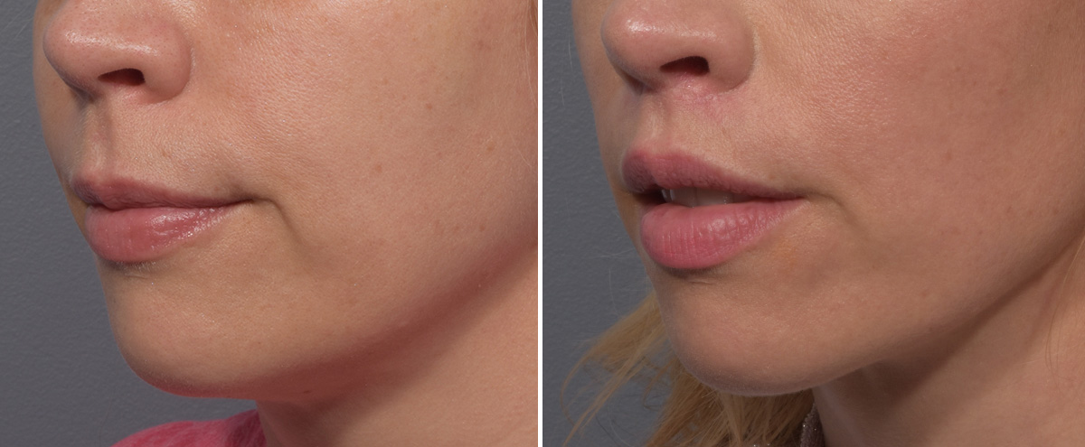 Lip Lift Before & After Gallery - Patient 393918 - Image 4