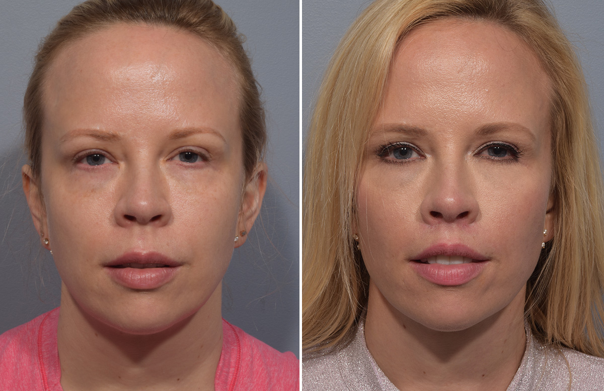 Lip Lift Before & After Gallery - Patient 393918 - Image 6