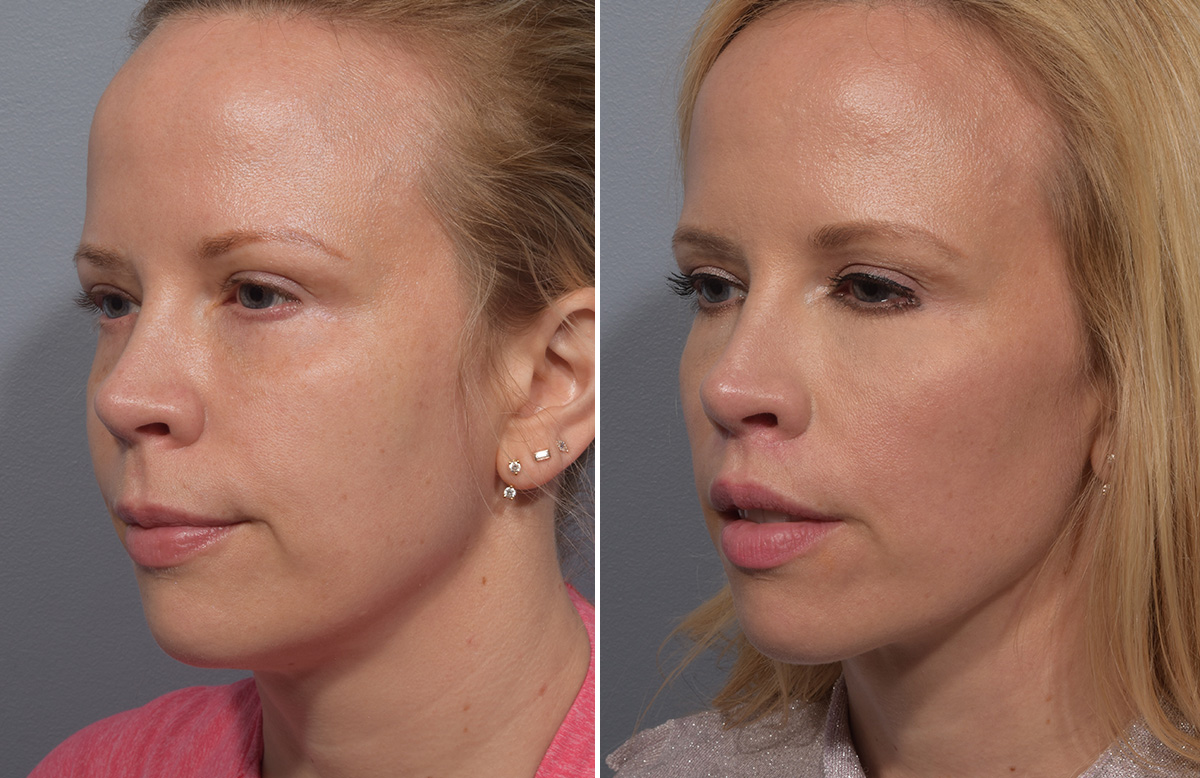 Lip Lift Before & After Gallery - Patient 393918 - Image 9