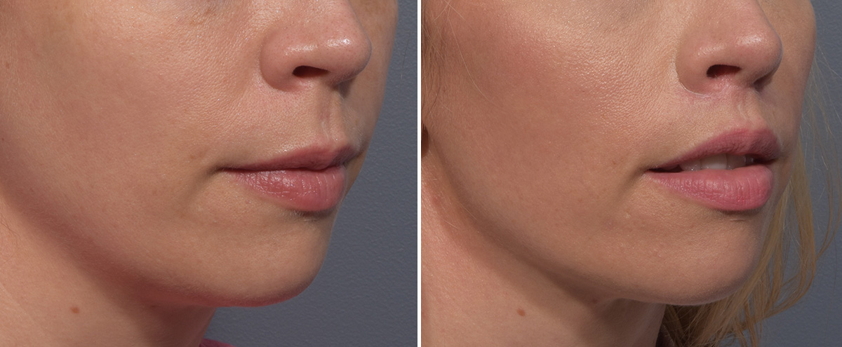 Lip Lift Before & After Gallery - Patient 393918 - Image 2