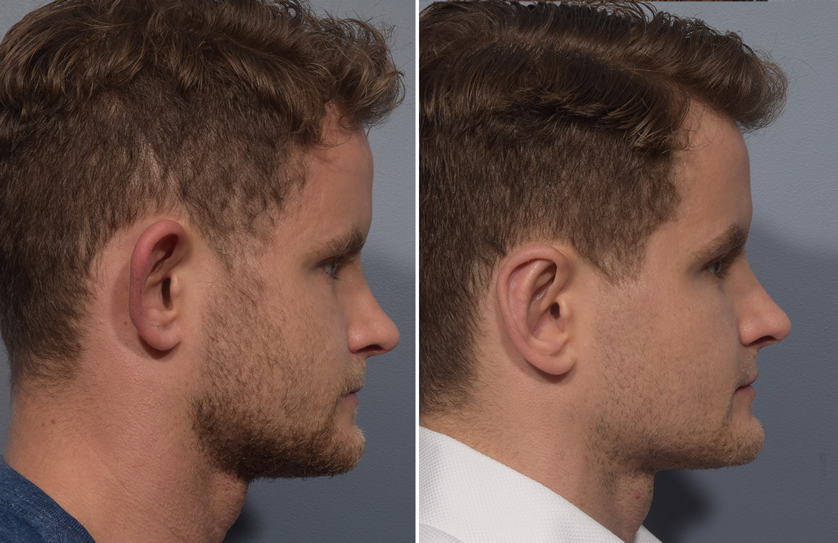 Otoplasty Before & After Gallery - Patient 344885 - Image 3