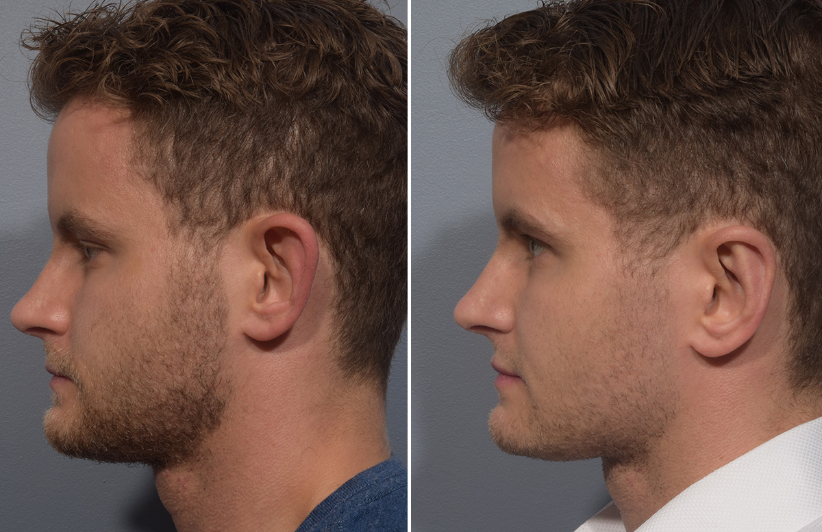 Otoplasty Before & After Gallery - Patient 344885 - Image 5