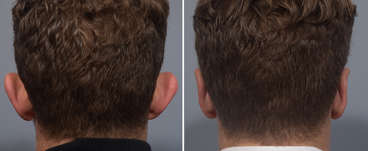 Otoplasty Before & After Gallery - Patient 344885 - Image 6