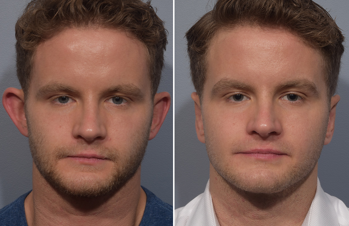 Otoplasty Before & After Gallery - Patient 344885 - Image 1