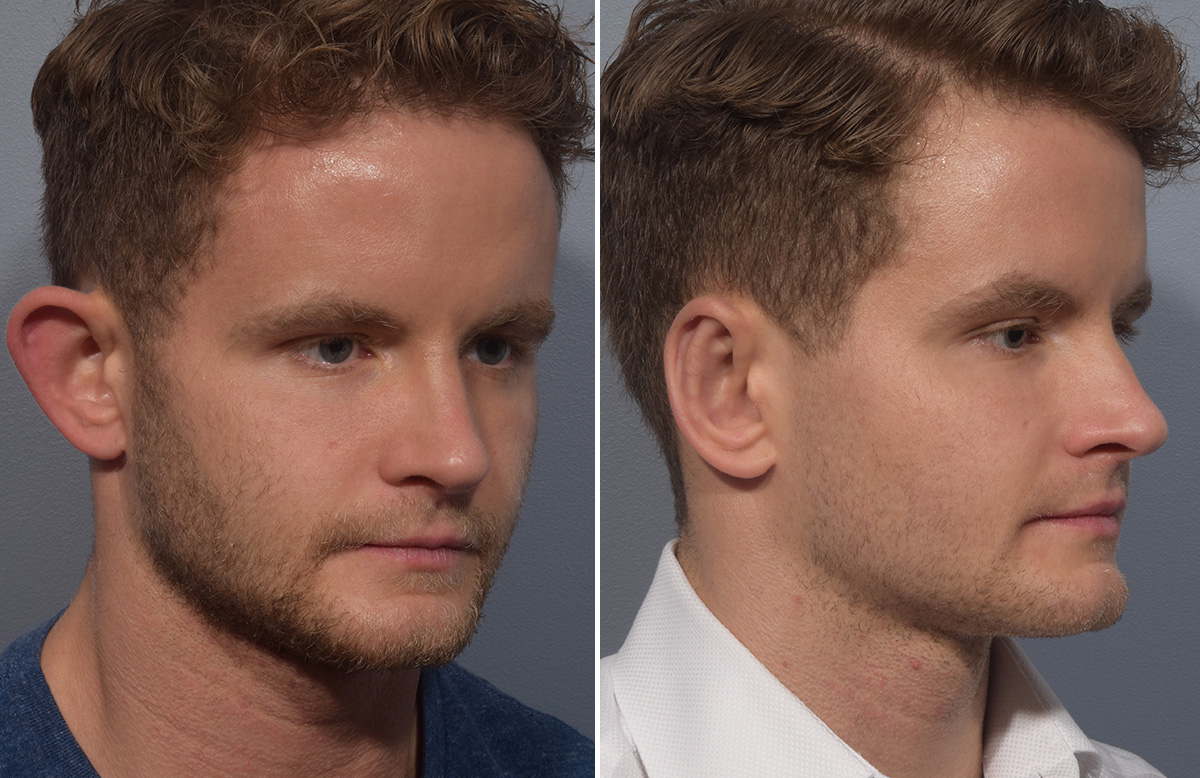 Otoplasty Before & After Gallery - Patient 344885 - Image 2