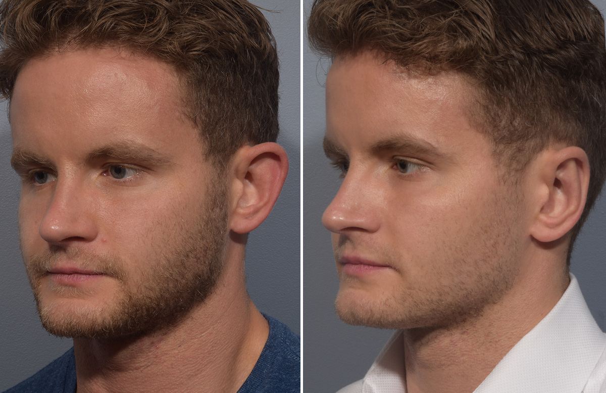 Otoplasty Before & After Gallery - Patient 344885 - Image 4
