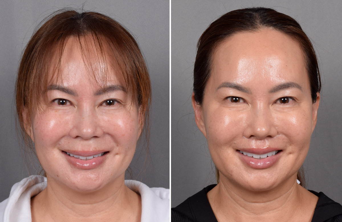 Lip Lift Before & After Gallery - Patient 310520 - Image 8